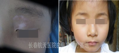 门诊案例：5岁女孩眼部白癜风2个月